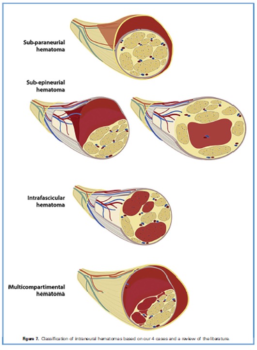 IL NEURO FASCIAL VASCULAR TRAINING (NFVT) COME EVOLUZIONE DELLA NEURODINAMICA NEL TRATTAMENTO DEGLI INTRAPPOLAMENTI NERVOSI PERIFERICI