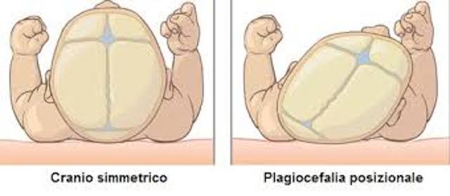 Plagiocefalia da posizione